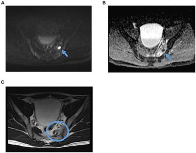 Frontiers Case Report A Case Of Piriformis Pyomyositis And Pyogenic